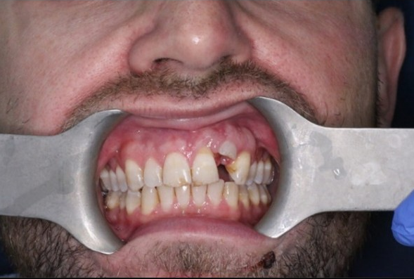 Dental trauma management - Pre-operative photo and X-ray case 1